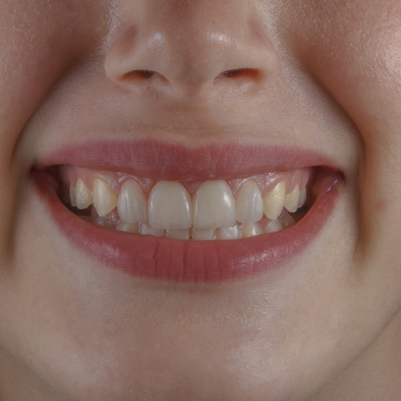 Why Do Teeth Develop Tiny Rough Edges as You Get Older?